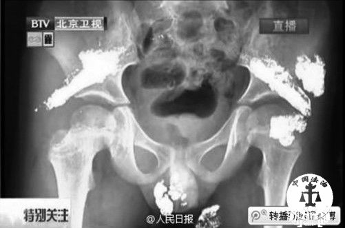 5岁男童臀部咋会挤出水银，小图中X光片疑为水银。